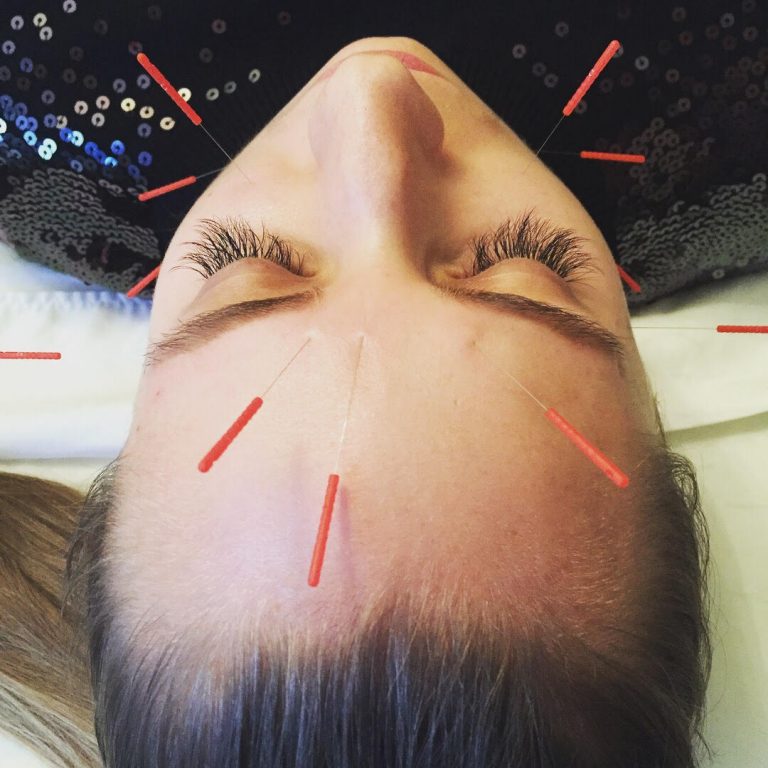 Relaxing woman with acupuncture needles applied to facial points.